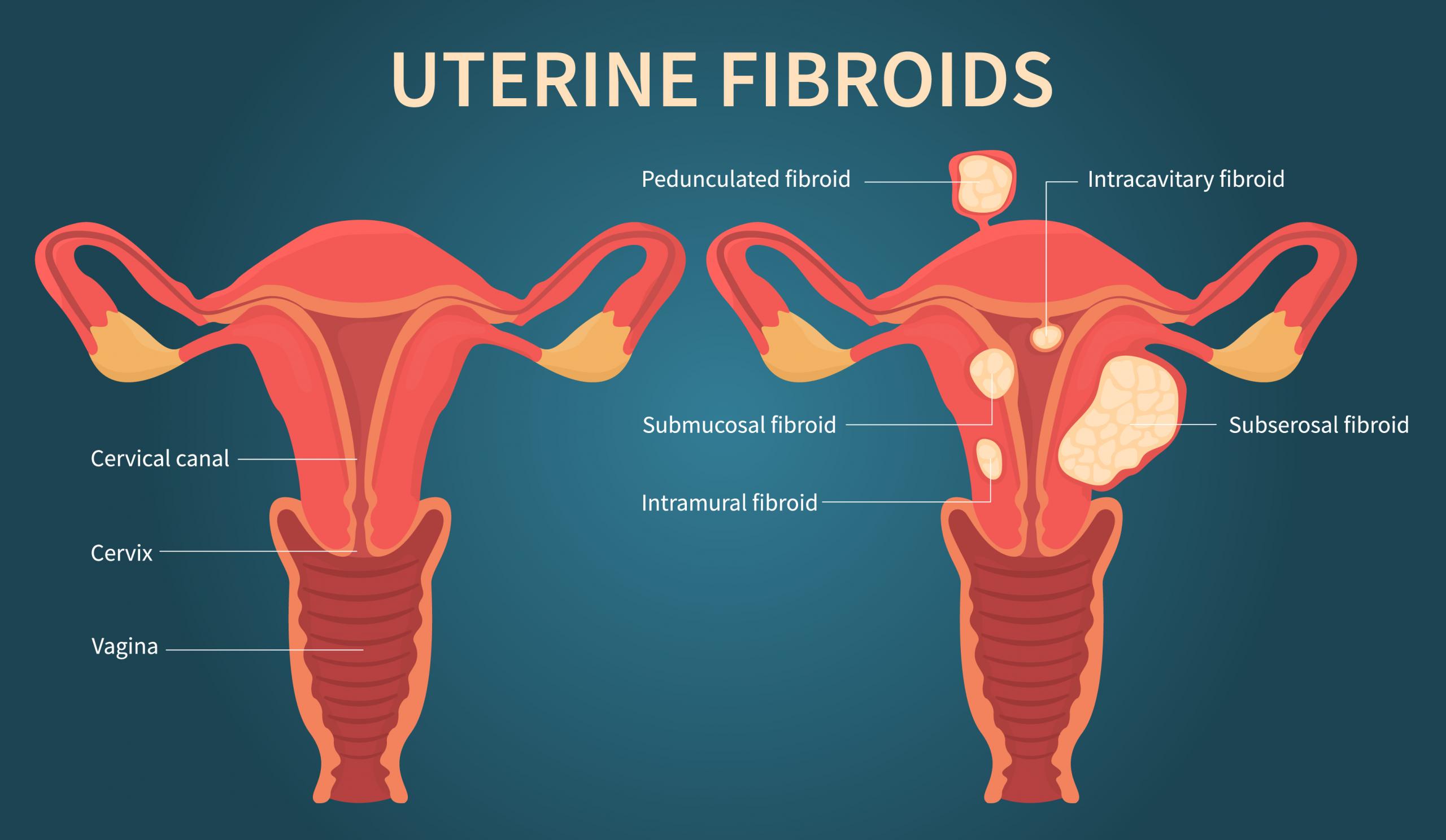 dissertation on uterine fibroids