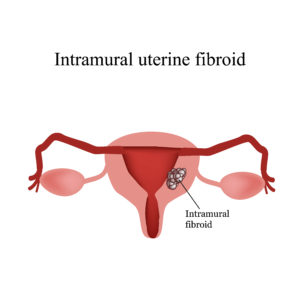 how fibroids are measured