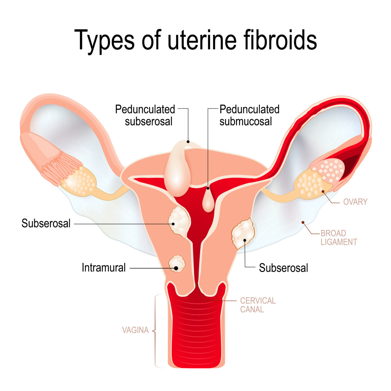 What Are The Symptoms Of Intramural Fibroids