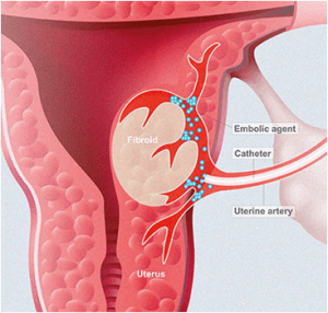 Labeled medical diagram of a fibroid in a uterus. 