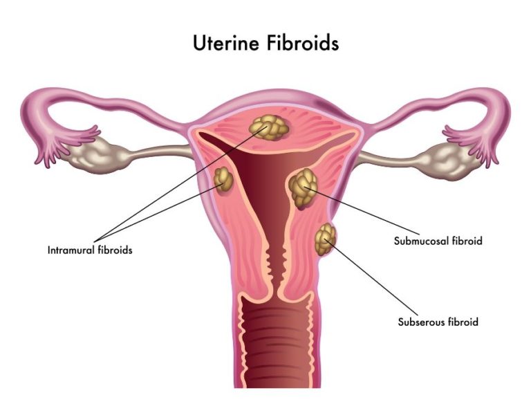 Ovarian Cysts And Fibroids Whats The Difference Usa Fibroid Centers 