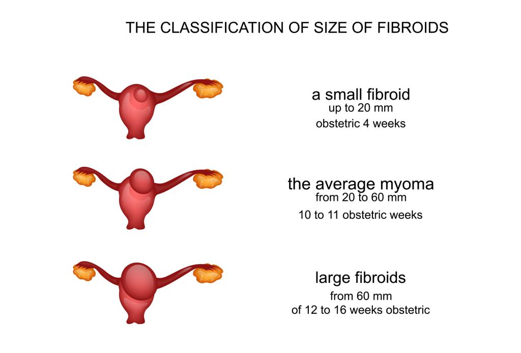 Normal Size Of Uterine Fibroids