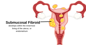 What Is Fibroid Expulsion? What You Need To Know