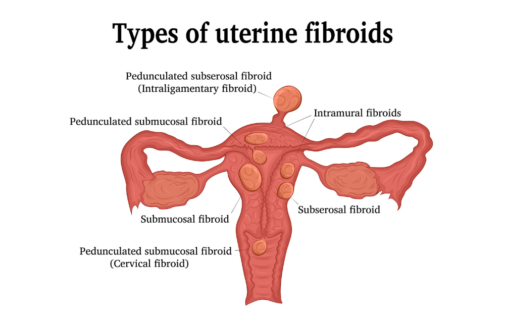 Fibroid Degeneration