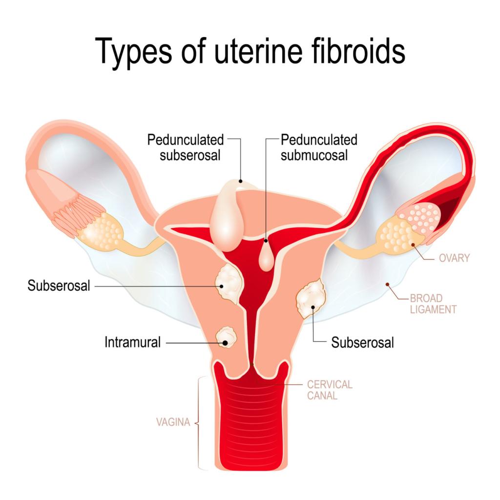 uterus fibroid ultrasound